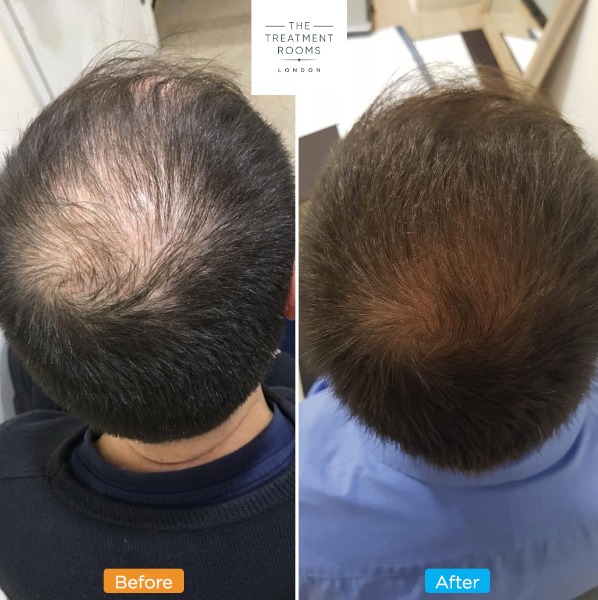 Crown Hair Growth